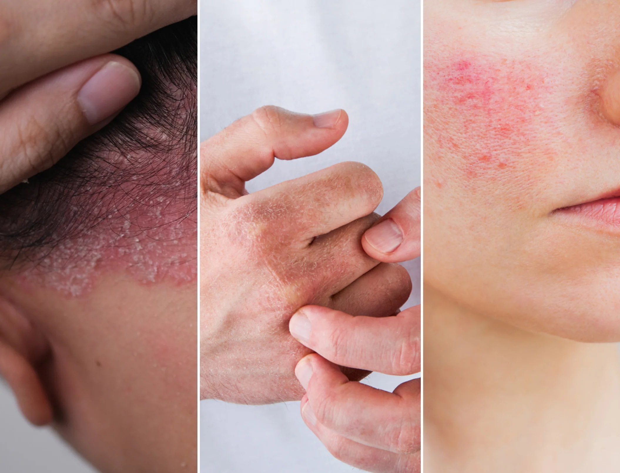 Rosacea, Eczema and Psoriasis