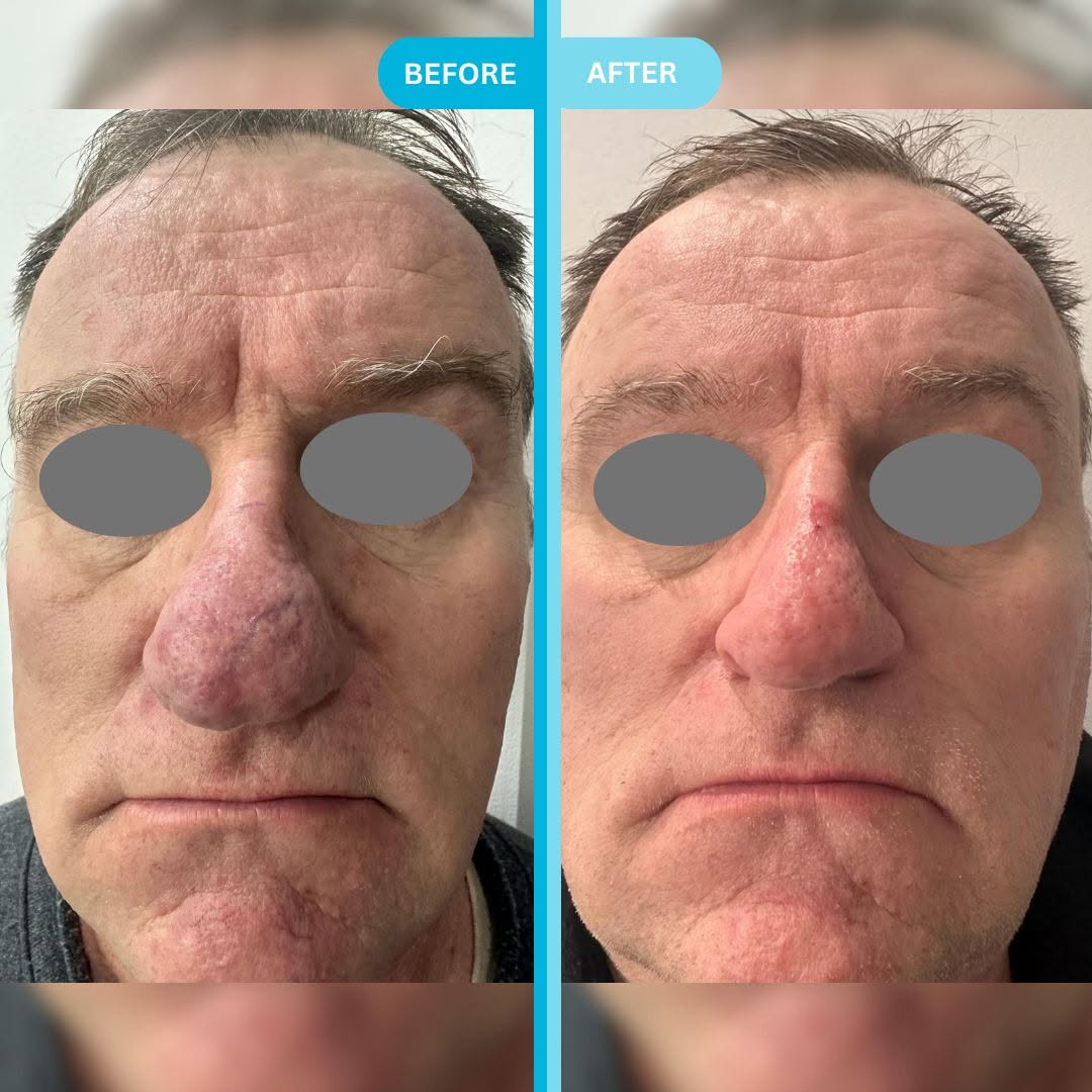 Traitement du Rhinophyma Montréal, Laval, Rive-Sud & Ottawa