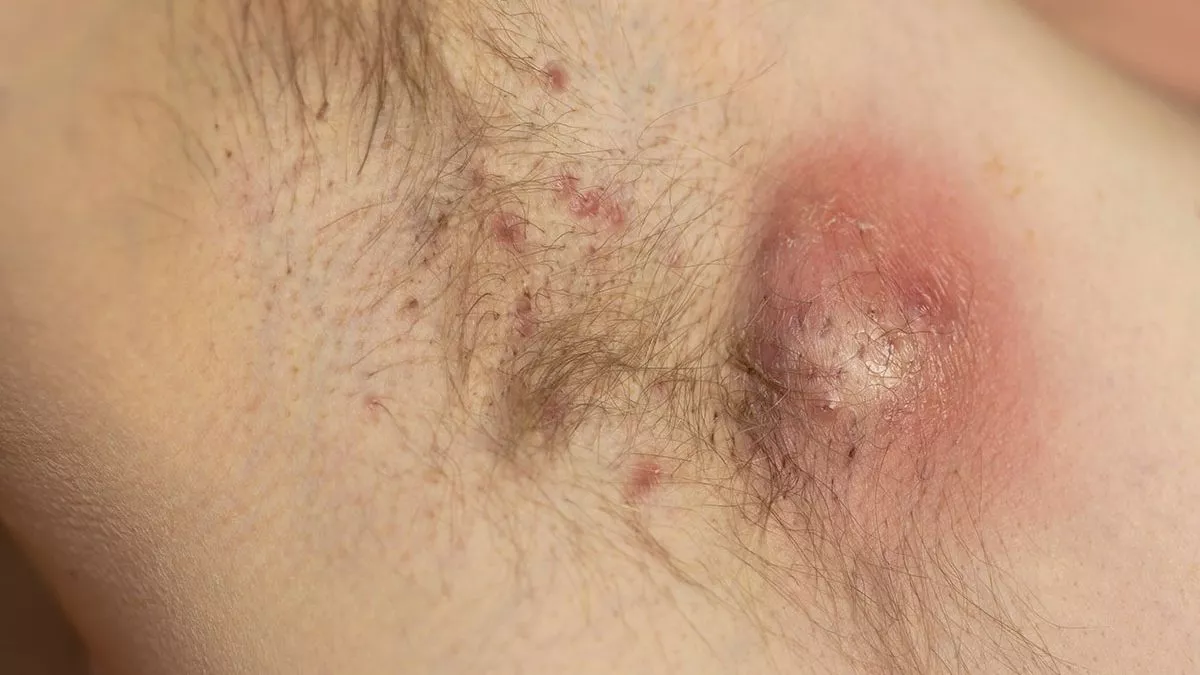Hidradenitis Suppurativa Montreal, Laval and West Island