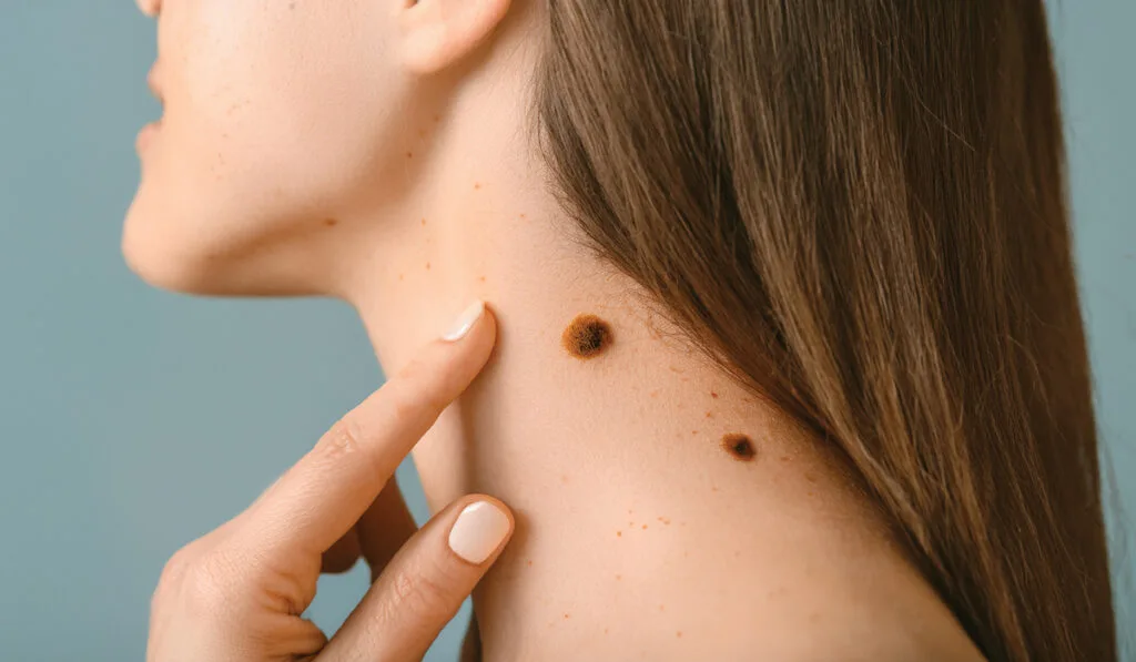 Enlever des Grains de beauté, Kystes,  Lipomes et  Verrues