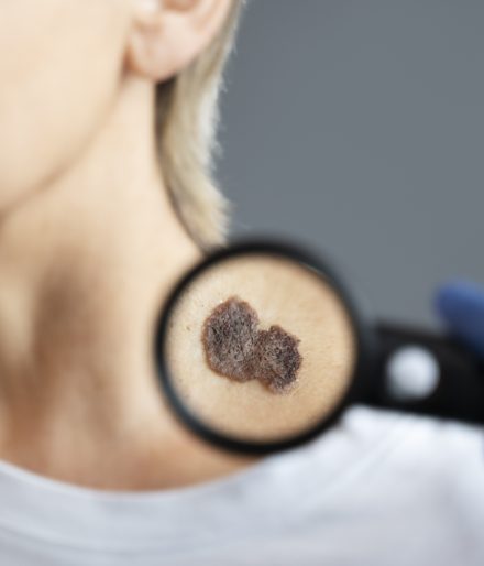 Comment traiter la kératose actinique avec un minimum d&rsquo;effets secondaires