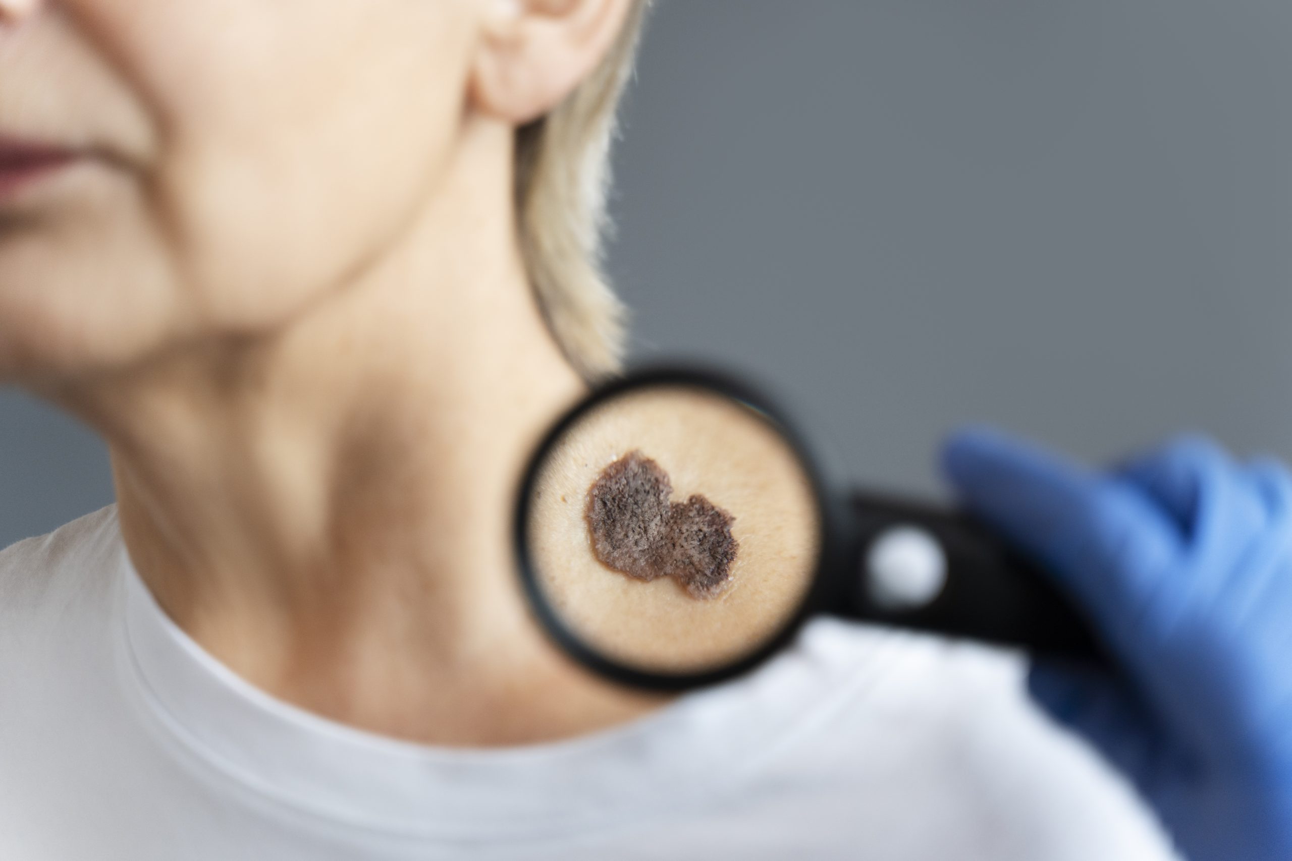 How to Treat Actinic Keratosis with Minimal Side Effects