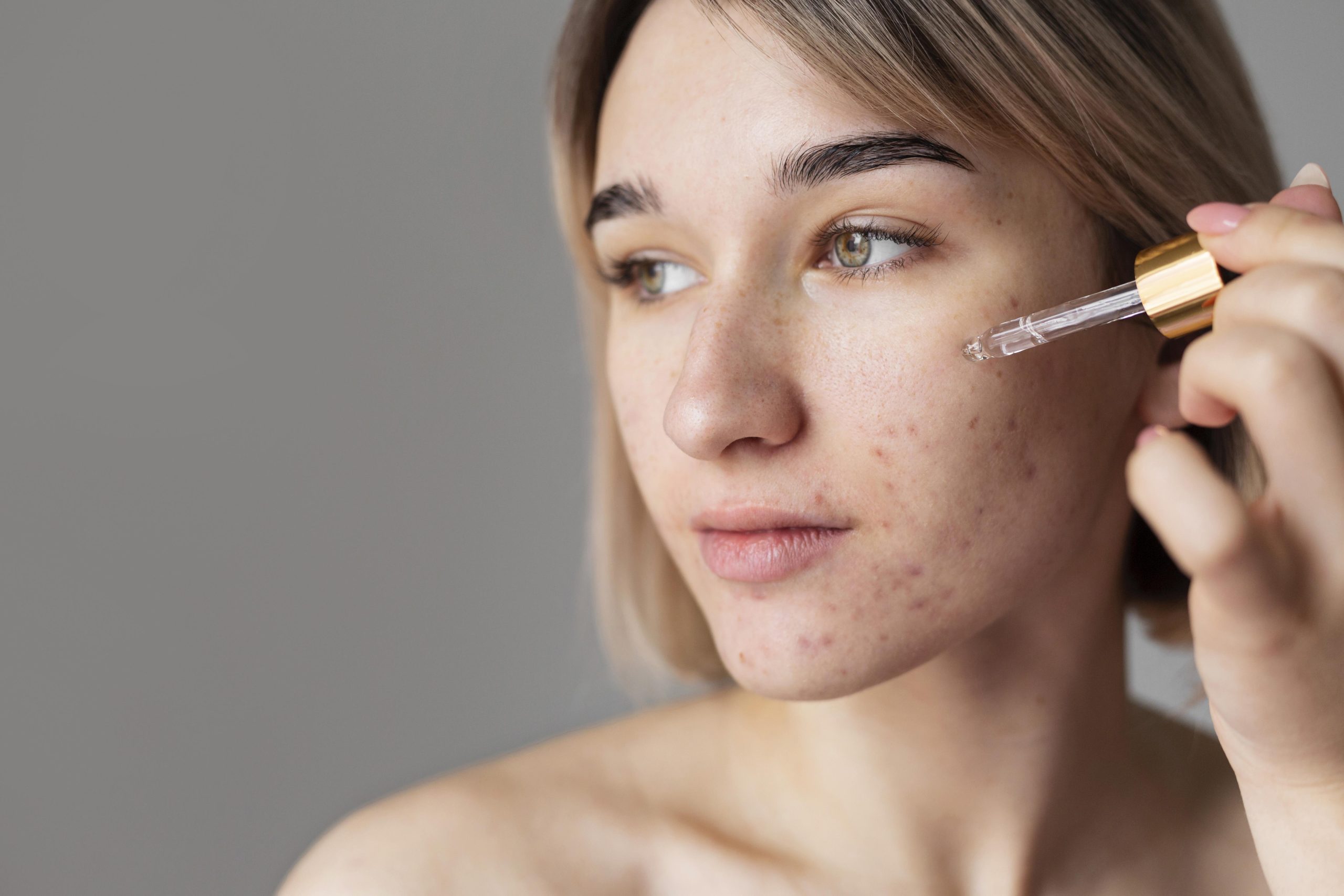 Acne Treatment in Montreal: What a Dermatologist Can Do That Your Pharmacist Can’t