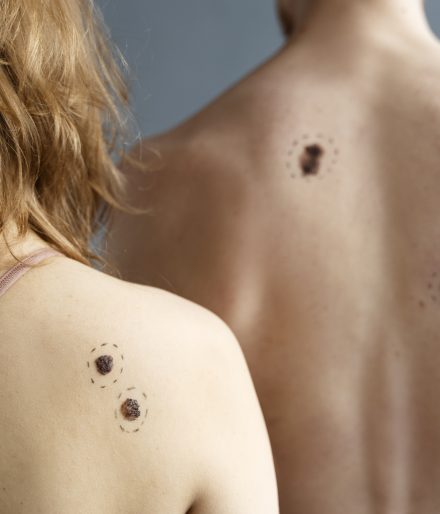 Peut-on prévenir les cicatrices chéloïdes après une intervention chirurgicale ou un piercing ?