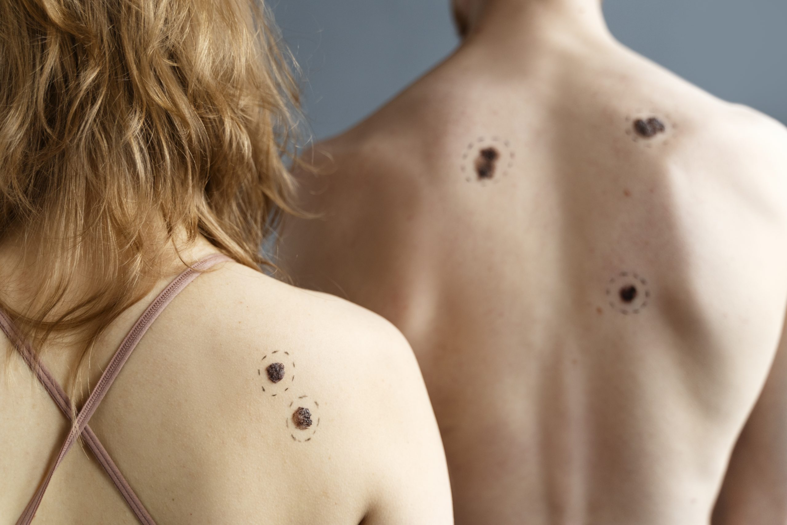 Peut-on prévenir les cicatrices chéloïdes après une intervention chirurgicale ou un piercing ?